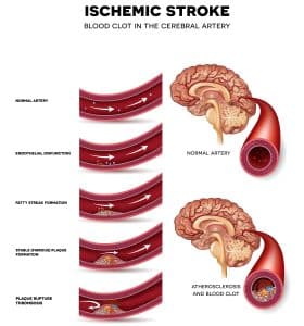 What You Should Know About Ischemic Stroke