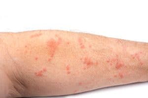 Scabies Is a Sign of Nursing Home Neglect
