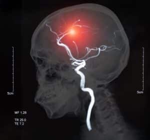 A New Worry About Falling and Hitting Your Head: A Higher Risk of Stroke