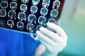 What Is a “Silent” Stroke?