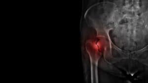 Broken Hips in Nursing Homes